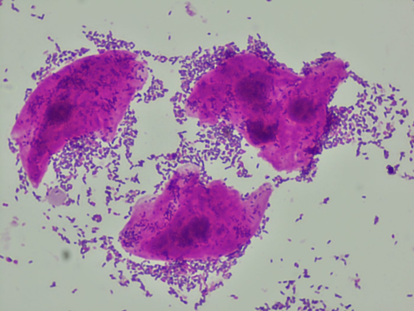 Microscopia de flora vaginal alterada — vaginose bacteriana